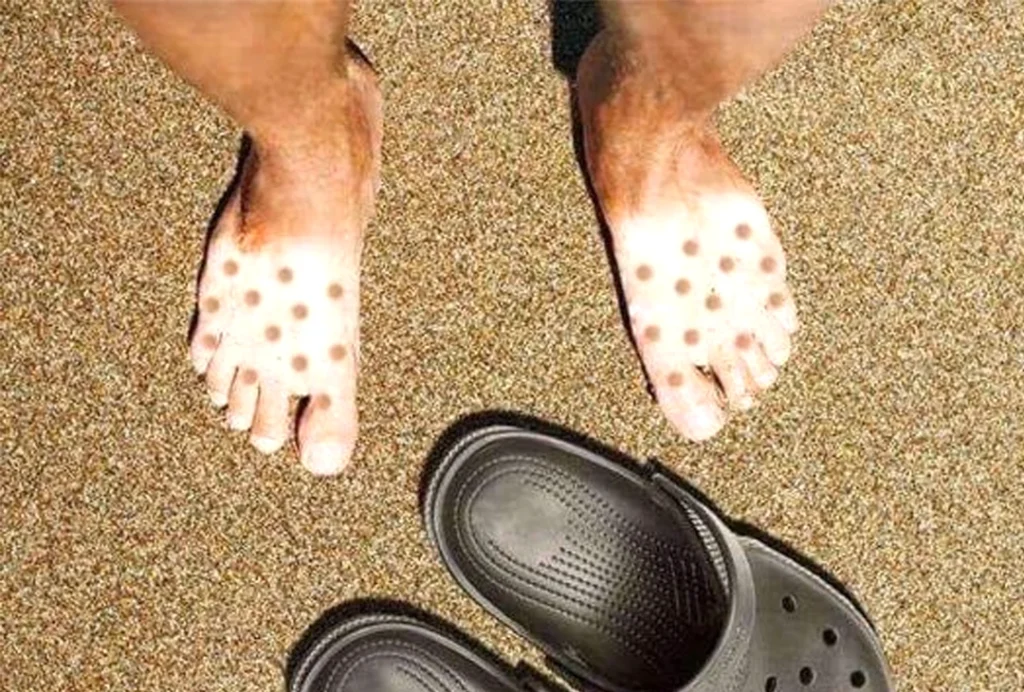 coup de soleil